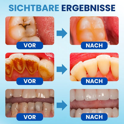 AEXZR® Postbiotisches Anti-Plaque Mundserum✨ Wissenschaft, die Ihrem Lächeln neues Leben einhaucht ✨