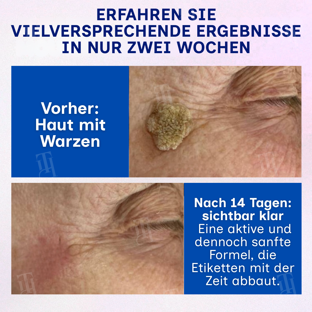 RZXEA™ | Solid-Stick-Warzenentferner, Hautanhängsel in nur 48 Stunden!