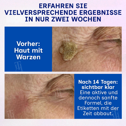 RZXEA™ | Solid-Stick-Warzenentferner, Hautanhängsel in nur 48 Stunden!