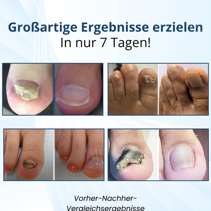 AEXZR® MycoShield Pro Pilznagelpflaster🌟 Durchbruch: Über Nacht zu stärkeren Nägeln