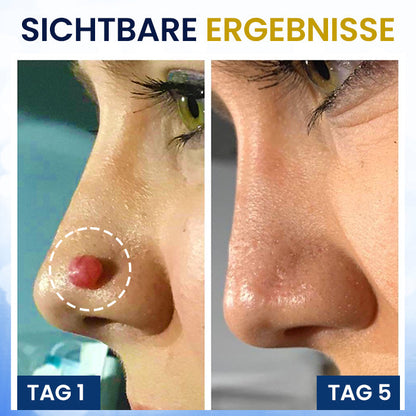 AEXZR® Hautanhängsel-Kryo-Behandlungsspray🧊 Präzisions-Kryotechnik: Vereist Stielwarzen & Warzen in Sekunden – Ohne Klingen, ohne Schmerzen.